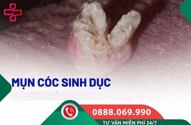 Mụn cóc sinh dục