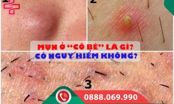 Mụn ở “cô bé” là gì? Có nguy hiểm không?