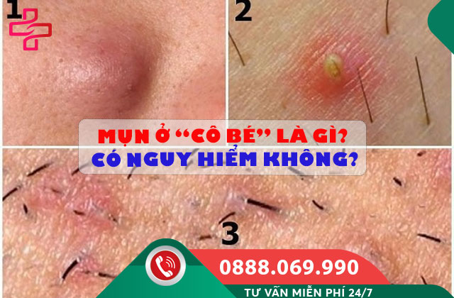 Mụn ở “cô bé” là gì? Có nguy hiểm không?