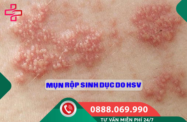 Mụn rộp sinh dục do HSV
