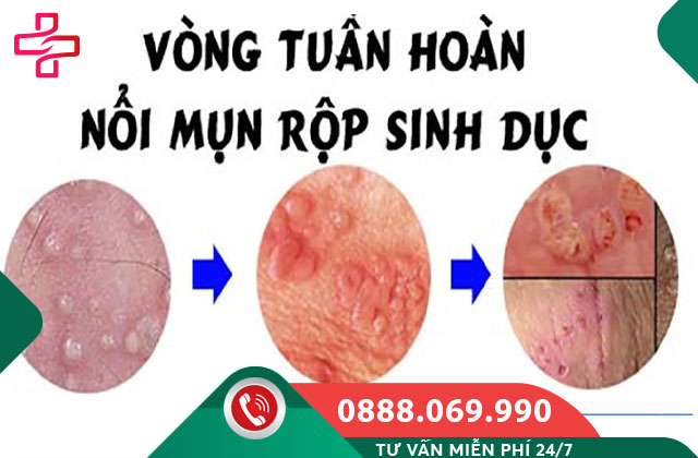 Mụn rộp sinh dục (Herpes sinh dục)