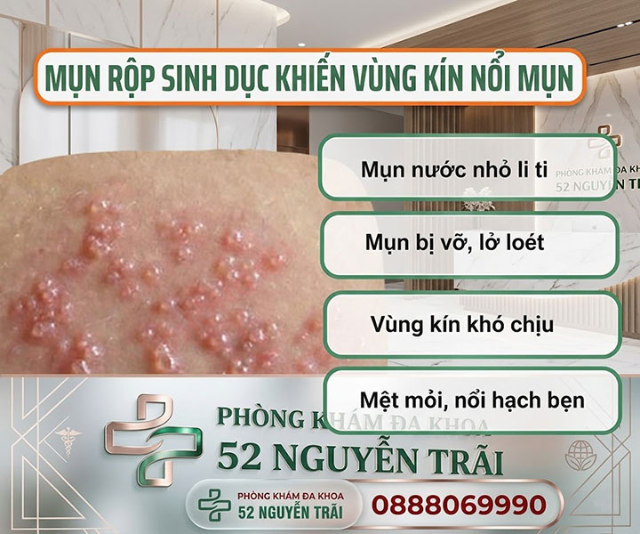 mụn rộp sinh dục