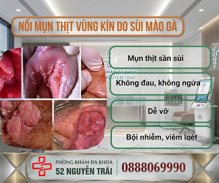 Mụn thịt sần sùi – Cảnh báo sùi mào gà