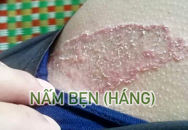 Nấm bẹn