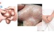 Ngứa bìu là dấu hiệu bệnh gì? Nguyên nhân và cách trị