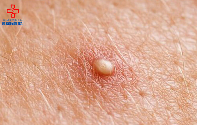 Nguyên nhân dương vật nổi mụn