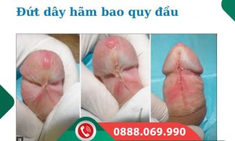 Đứt dây hãm bao quy đầu do đâu? Dấu hiệu cách điều trị