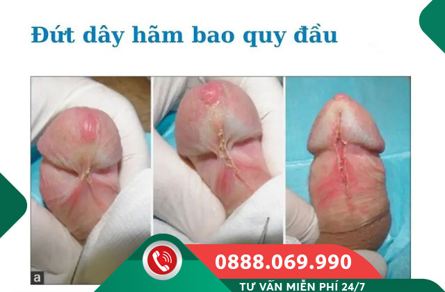 Nguyên nhân gây đứt dây hãm bao quy đầu