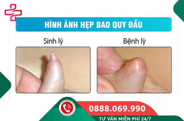 Nguyên nhân gây hẹp bao quy đầu ở trẻ em