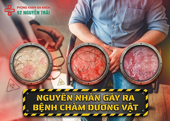 Nguyên nhân gây ra bệnh chàm dương vật