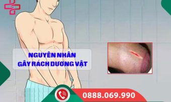 Rác dương vật là gì? Cách xử lý an toàn