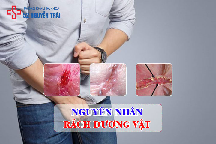 Rách dương vật là gì? Nguyên nhân, dấu hiệu và cách chữa