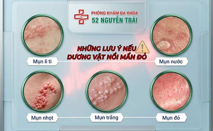 Những lưu ý nếu dương vật nổi mẩn đỏ