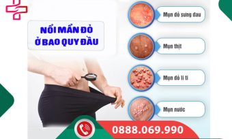 Nổi mẩn đỏ ở bao quy đầu