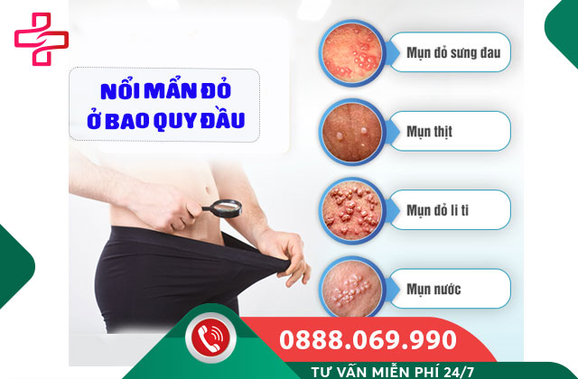 Nổi mẩn đỏ ở bao quy đầu