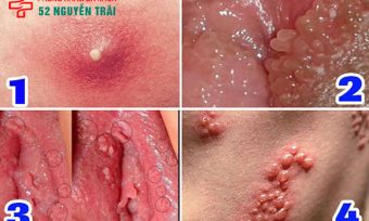 Nổi mụn ở cô bé là dấu hiệu gì? Nguyên nhân và cách chữa