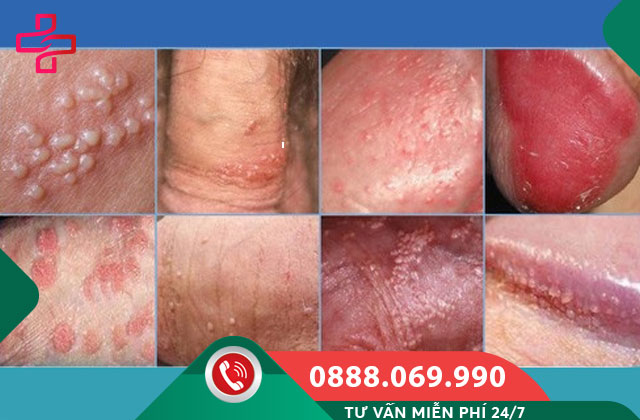 Phân biệt mụn lành tính và mụn bệnh lý ở dương vật