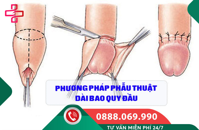 Phương pháp phẫu thuật dài bao quy đầu