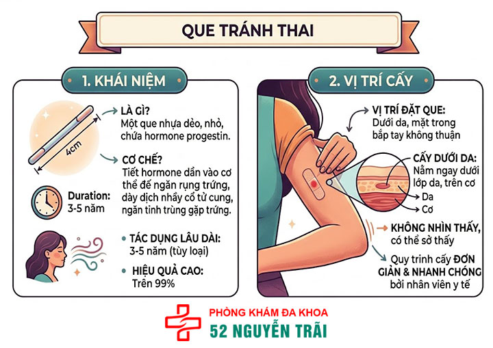 Cấy que tránh thai: Giải pháp ngừa thai hiện đại, an toàn 1 que tránh thai là gì
