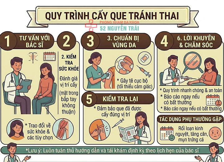 Cấy que tránh thai: Giải pháp ngừa thai hiện đại, an toàn 10 Quy trình cấy que tránh thai