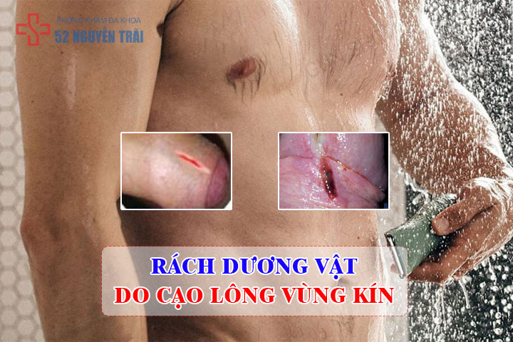 Rách dương vật do cạo lông vùng kín