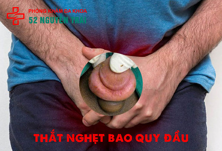 Thắt nghẹt bao quy đầu