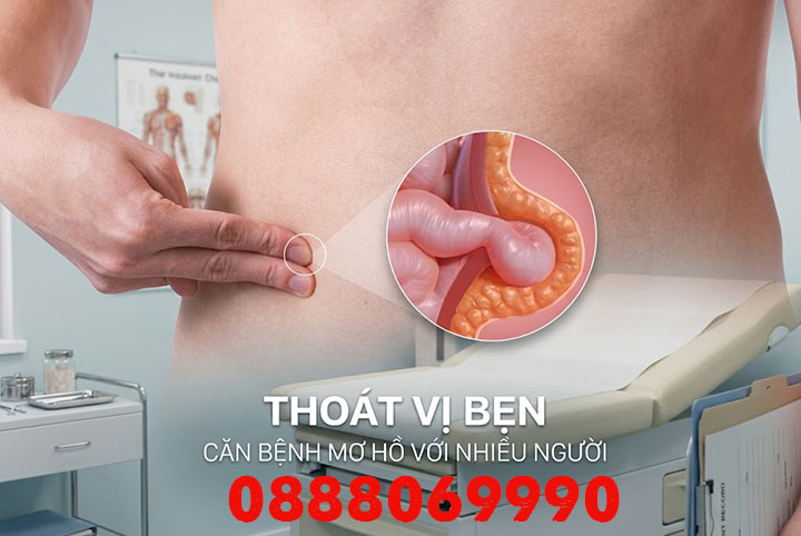 Đau nhức tinh hoàn tại sao? Dấu hiệu của của bệnh gì? 7 Thoát vị bẹn