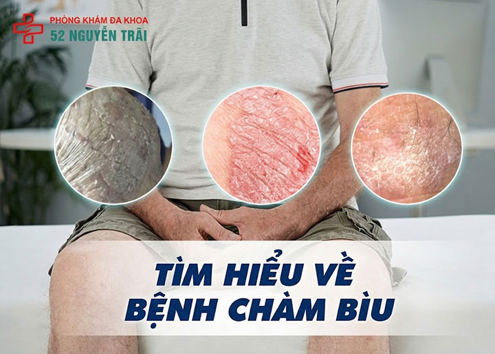 Bệnh chàm bìu là gì? Nguyên nhân, dấu hiệu và cách điều trị