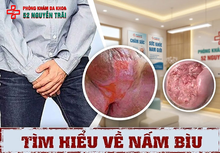 Nấm bìu là gì? Nguyên nhân, dấu hiệu, cách điều trị hiệu quả