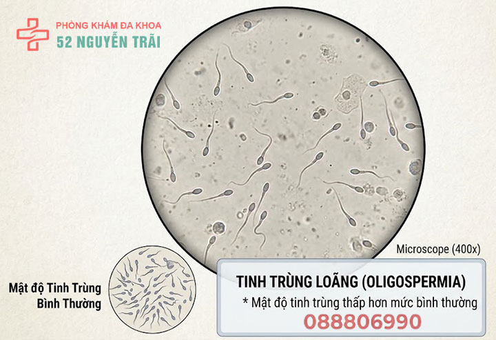 Tinh trùng loãng như nước: có con được không? Điều trị cách nào nhanh nhất? 1 tinh trùng loãng