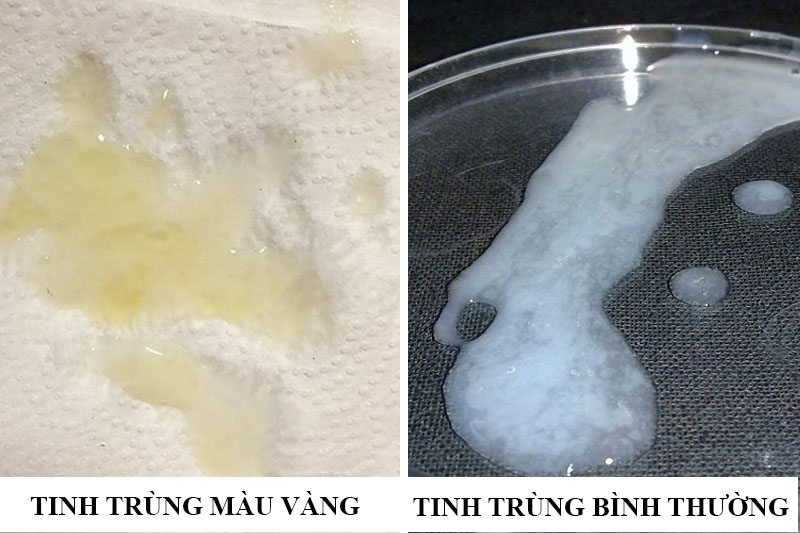 Tinh trùng màu vàng