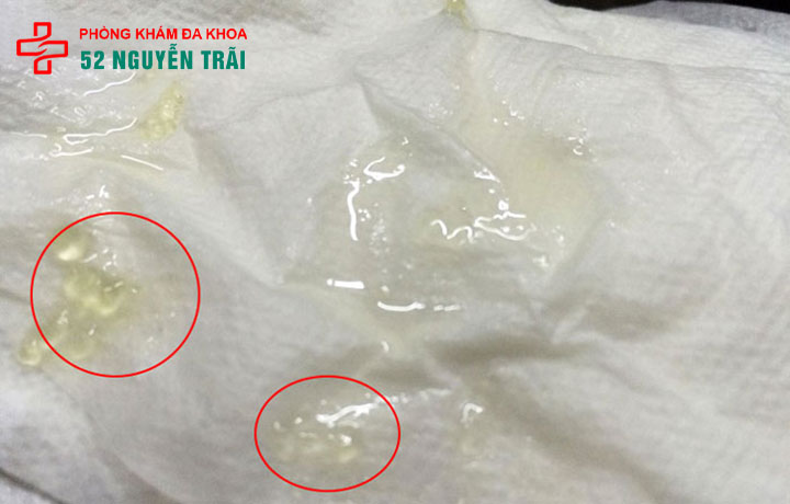 Tinh trùng vón cục như thạch: có nguy hiểm không? Điều trị cách nào nhanh nhất? 1 tinh trùng vón cục