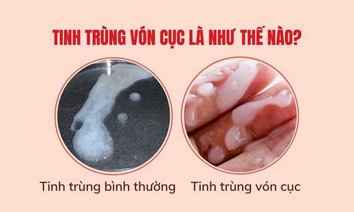 Tinh trùng vón cục