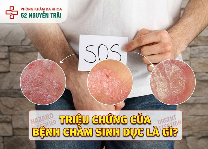 Triệu chứng của bệnh chàm sinh dục