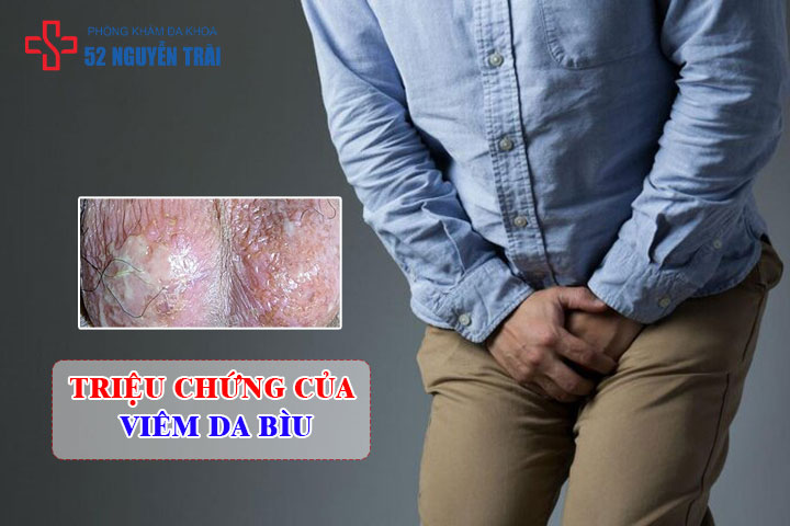 Triệu chứng của viêm da bìu
