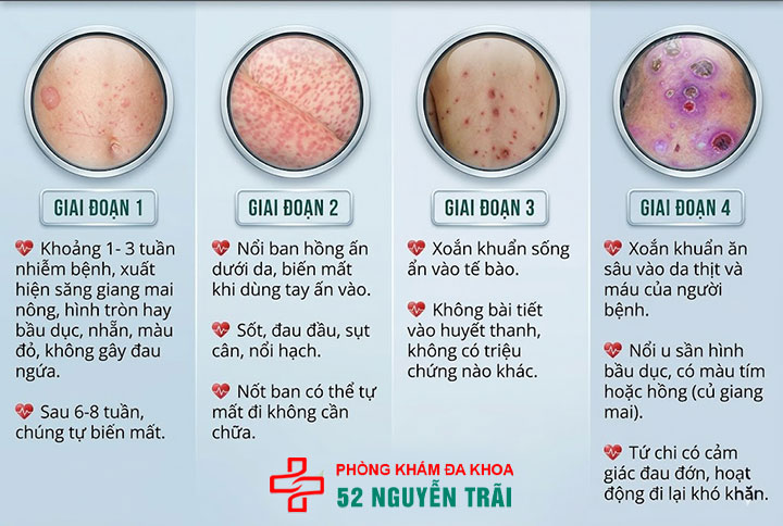 triệu chứng giang mai