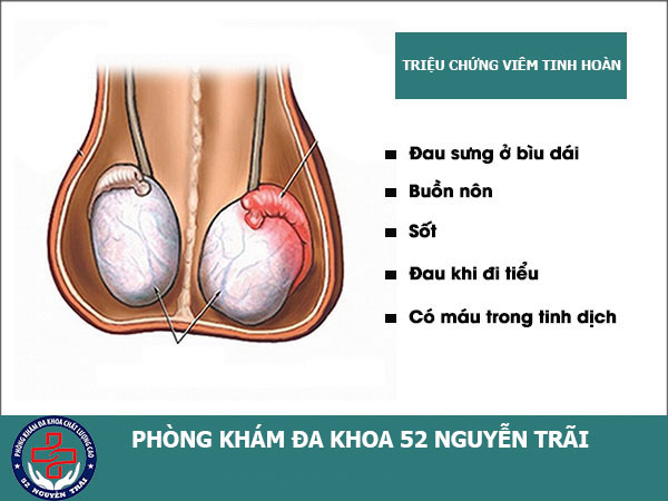 Triệu chứng của bệnh viêm tinh hoàn