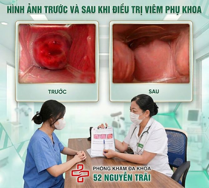 trước và sau khi điều trị viêm phụ khoa