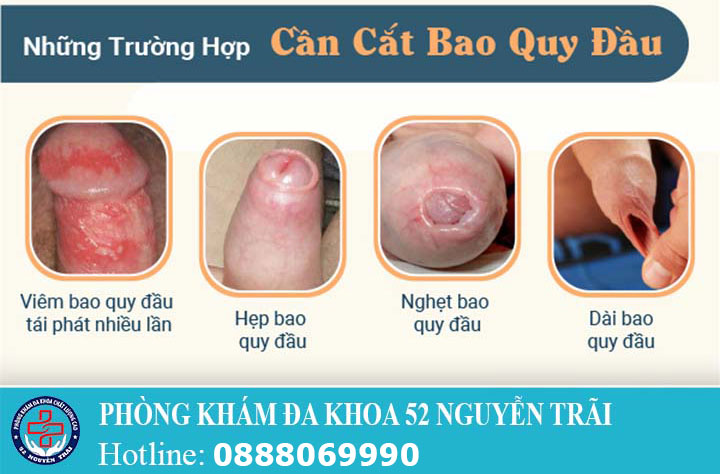 Quy trình cắt bao quy đầu