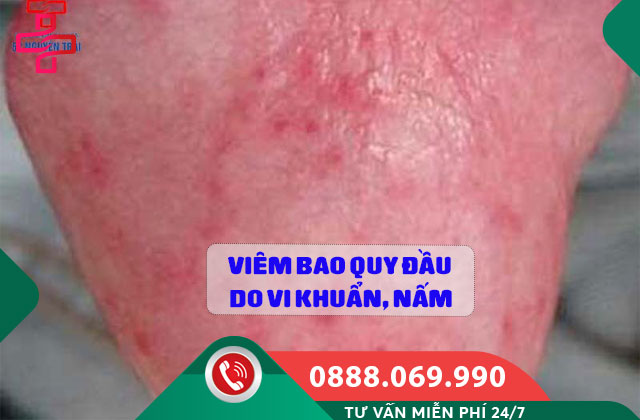 Viêm bao quy đầu do vi khuẩn, nấm