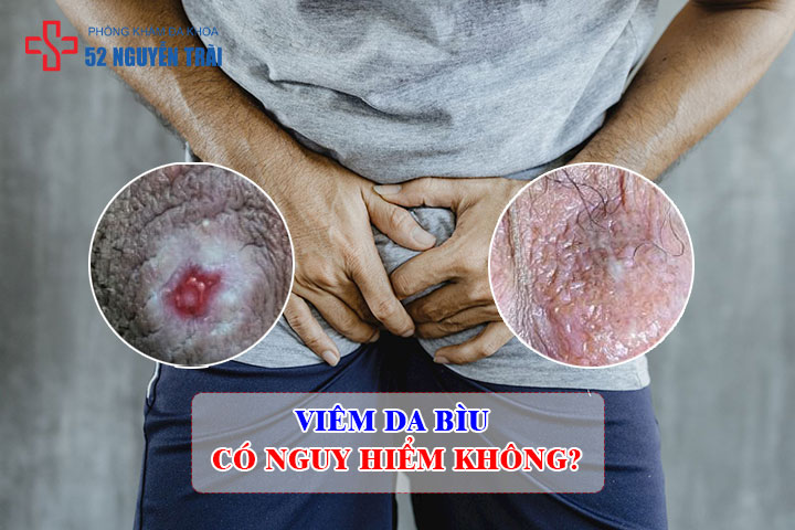 Viêm da bìu có nguy hiểm không