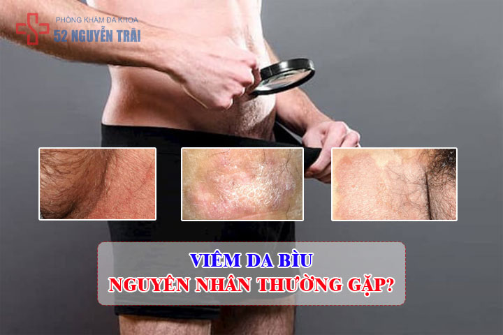 Viêm da bìu là gì? Nguyên nhân, dấu hiệu và cách điều trị