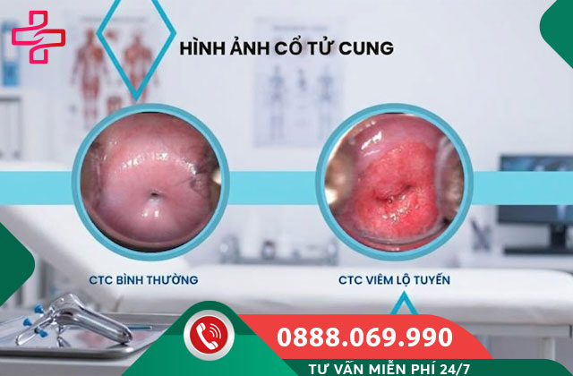Viêm lộ tuyến cổ tử cung