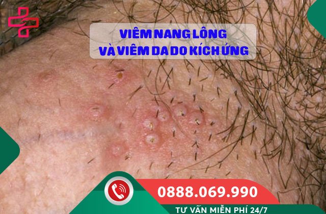 Viêm nang lông và viêm da do kích ứng