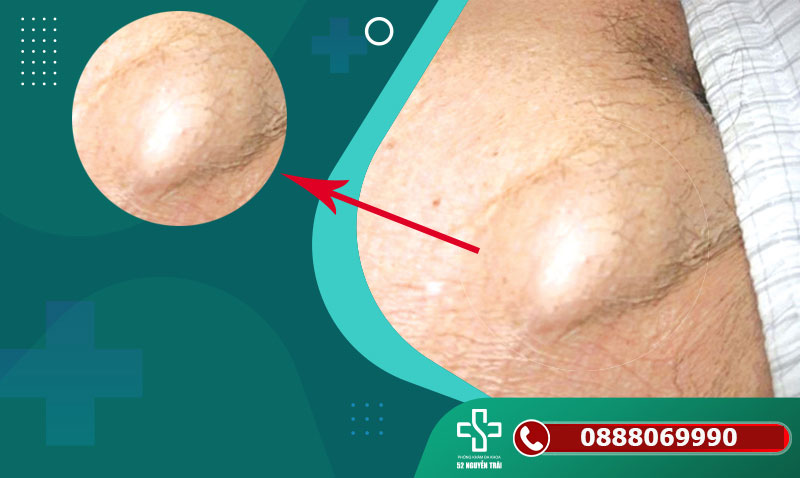 Vùng kín nổi hạch