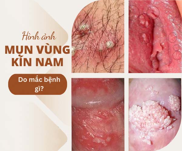Vùng kín nổi mụn