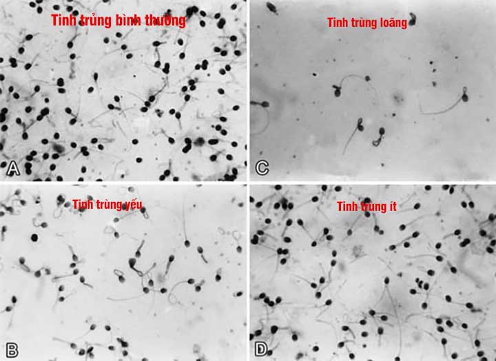 Xét nghiệm tinh dịch đồ