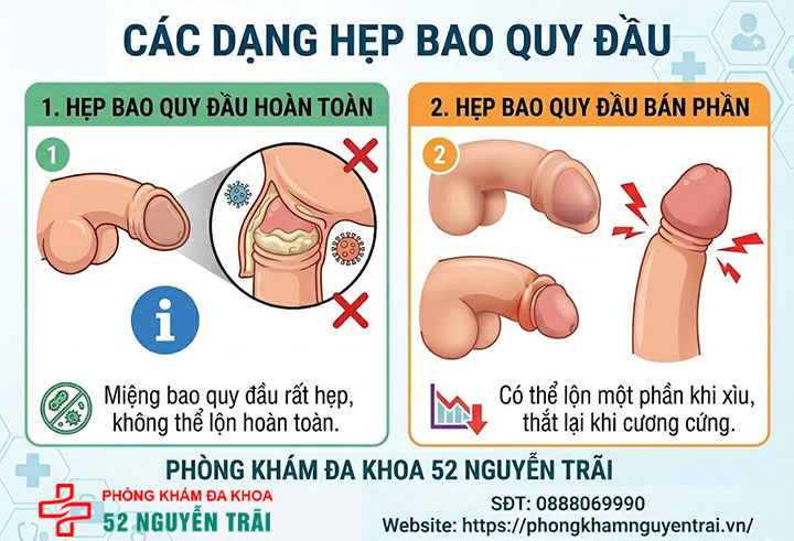 Hẹp bao quy đầu: Dấu hiệu nhận biết và cách điều trị an toàn 4 Ảnh minh hoạ Các dạng hẹp bao quy đầu