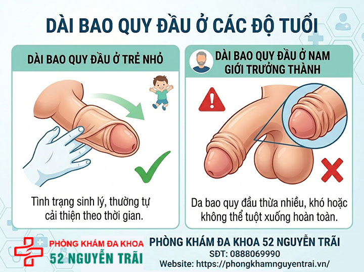 Dài hẹp bao quy đầu: Nguyên nhân và cách xử lý hiệu quả 2 Ảnh minh hoạ Dài bao quy đầu ở các độ tuổi
