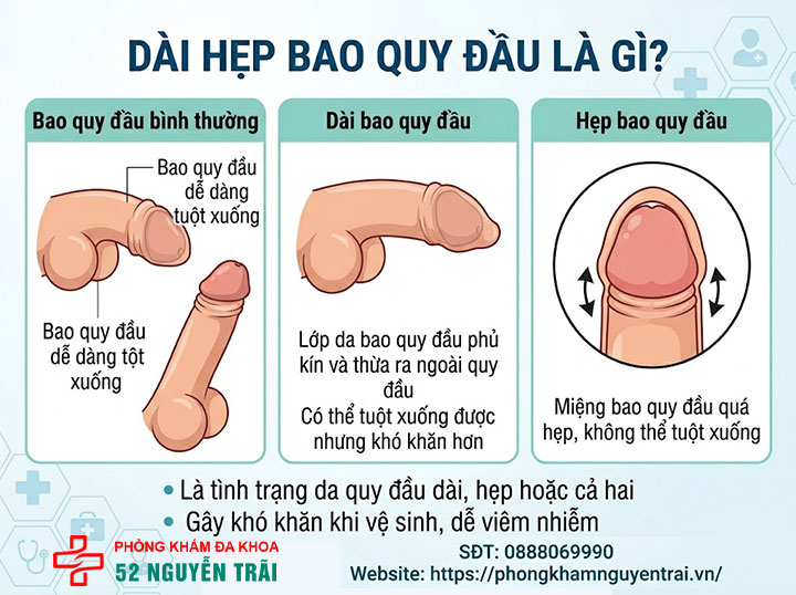 Dài hẹp bao quy đầu: Nguyên nhân và cách xử lý hiệu quả 1 Ảnh minh hoạ Dài hẹp bao quy đầu